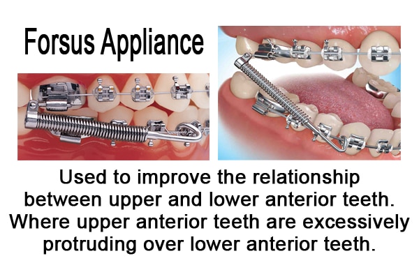 forsusappliance